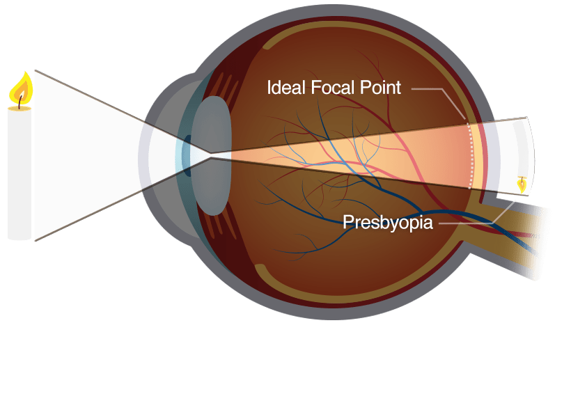 presbyopia